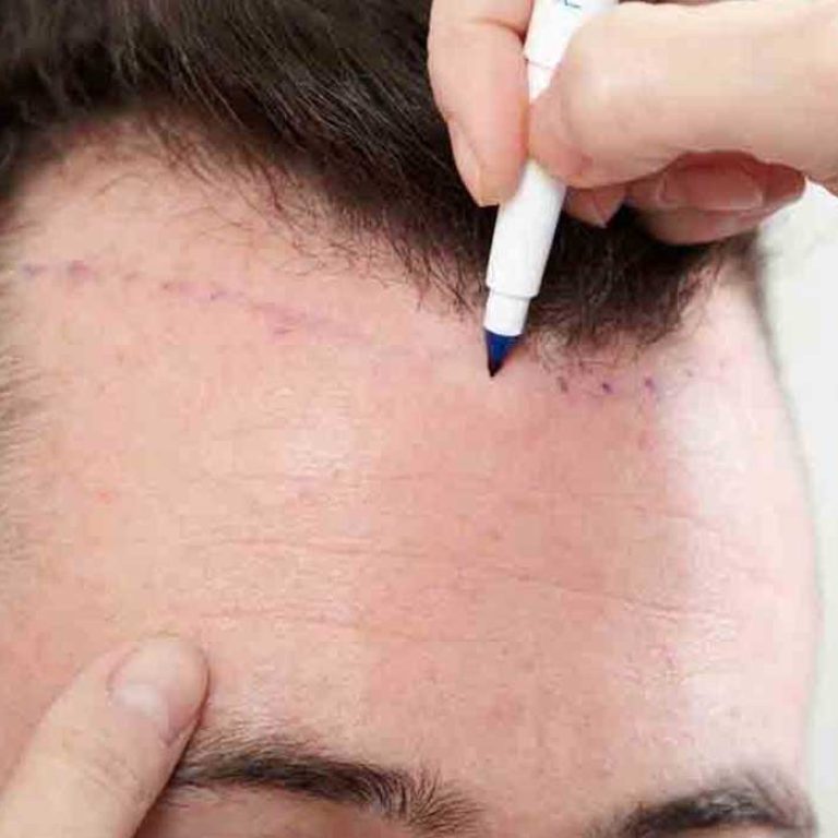 تكلفة زراعة الشعر