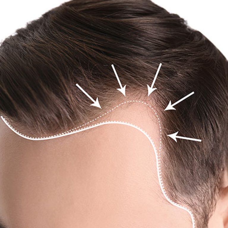 تكلفة زراعة الشعر