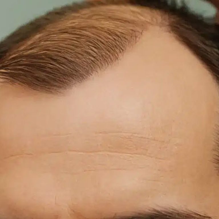 تكلفة زراعة الشعر في تركيا