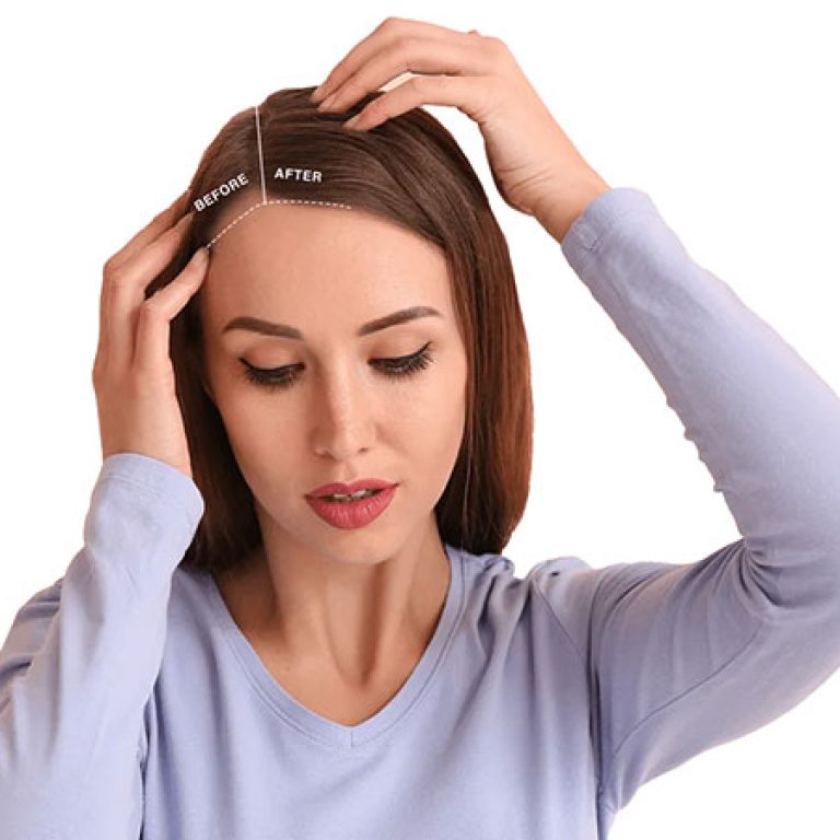 تكلفة زراعة الشعر للنساء في مصر