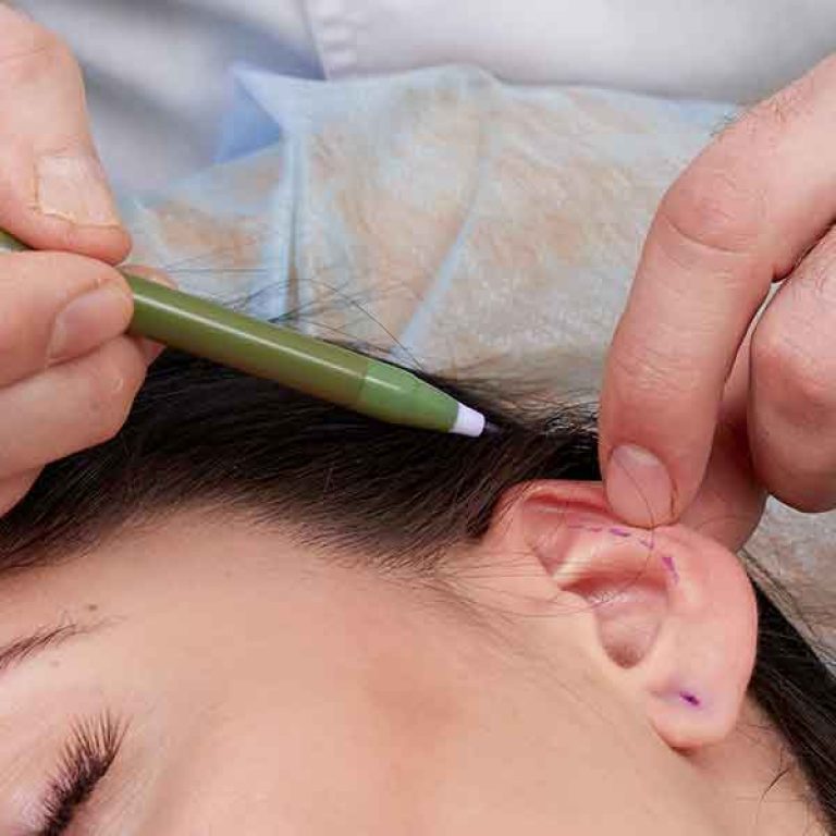 تكلفة عملية تجميل الاذن في مصر
