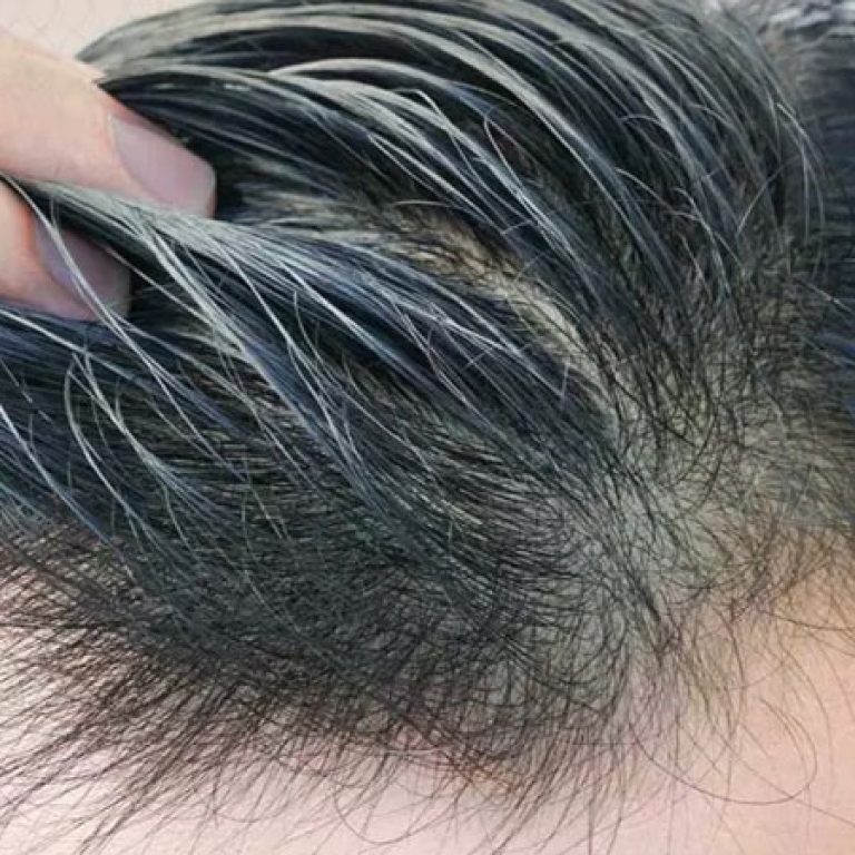 تكلفة عملية زرع الشعر