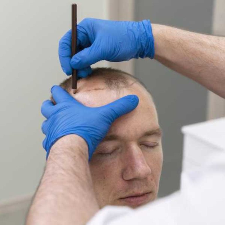 تورم الوجه بعد عملية زراعة الشعر