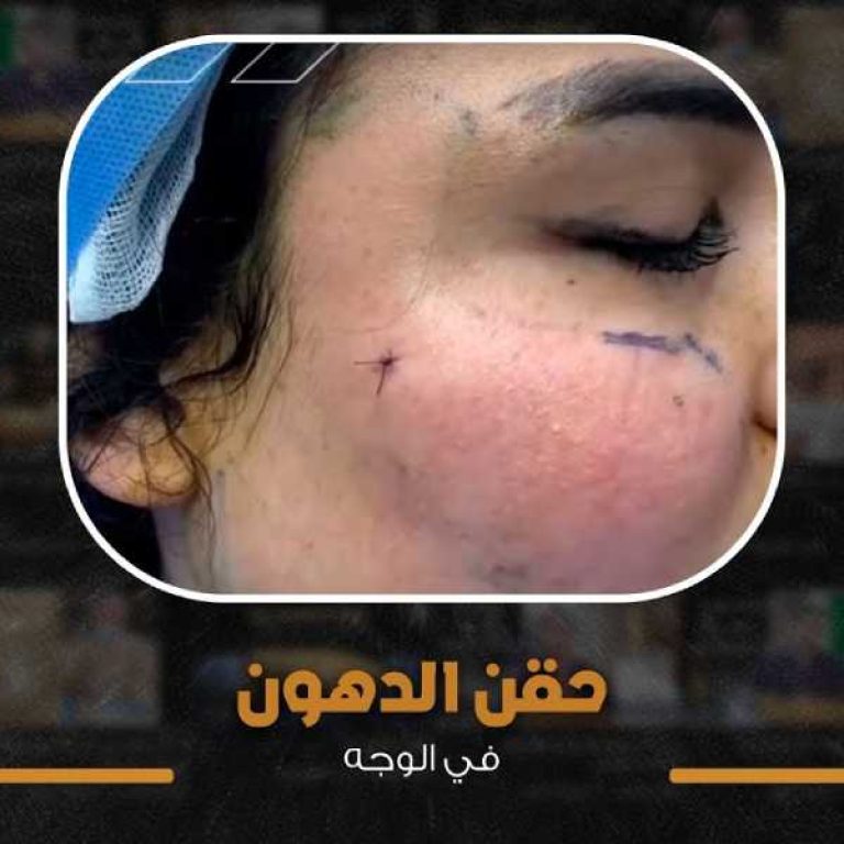 حقن دهون في الوجه