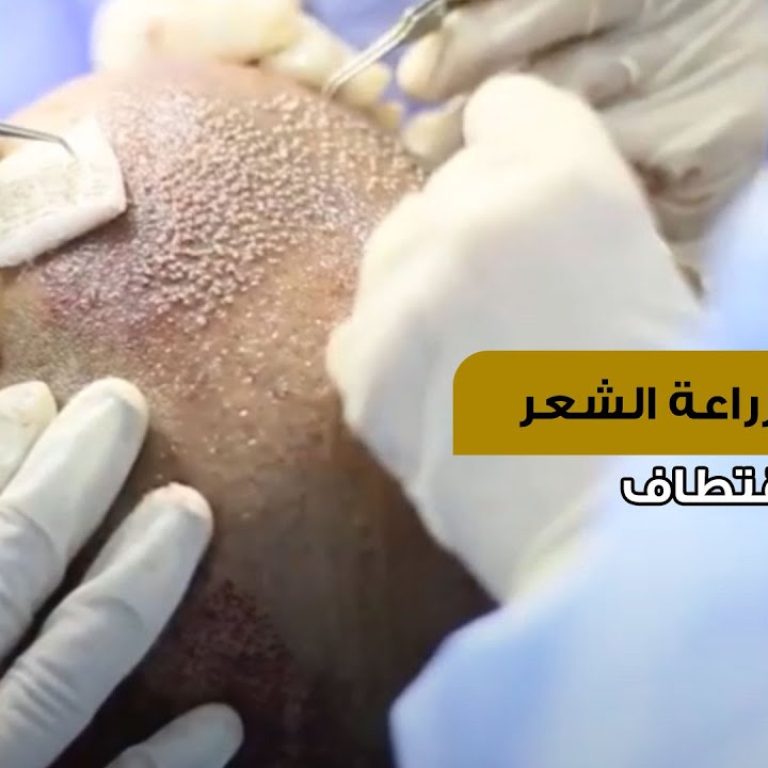 خطوات زراعة الشعر بالاقتطاف