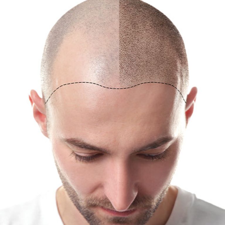 زراعة الشعر