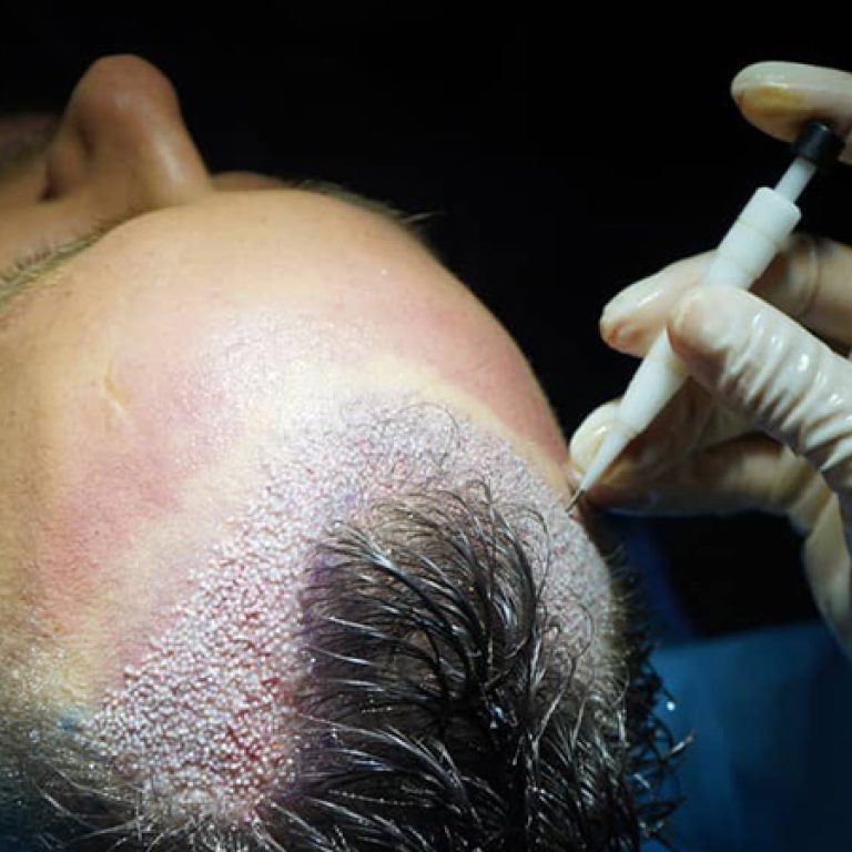 زراعة الشعر dhi 7