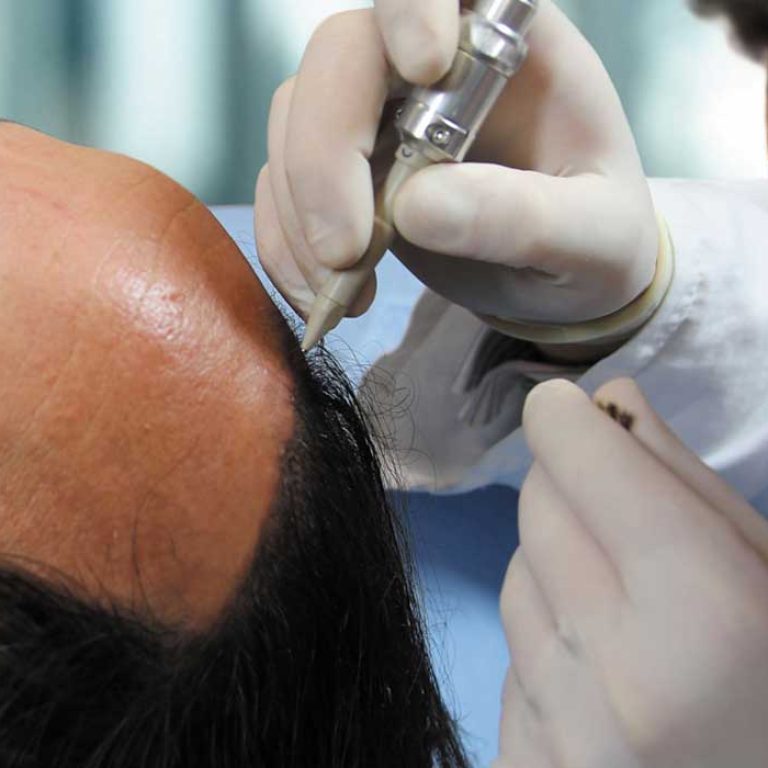 زراعة الشعر الصناعي