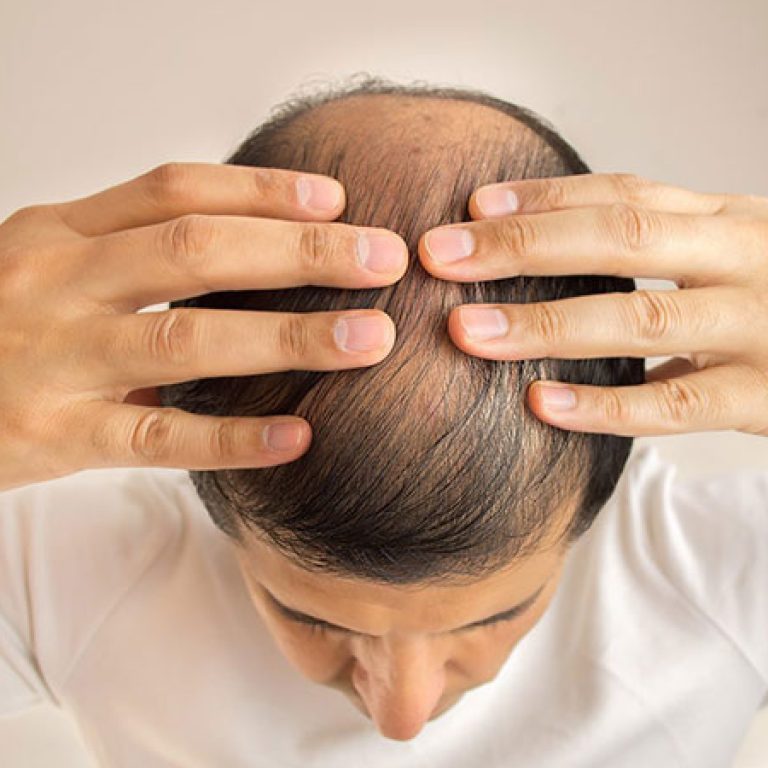 زراعة الشعر الصناعي