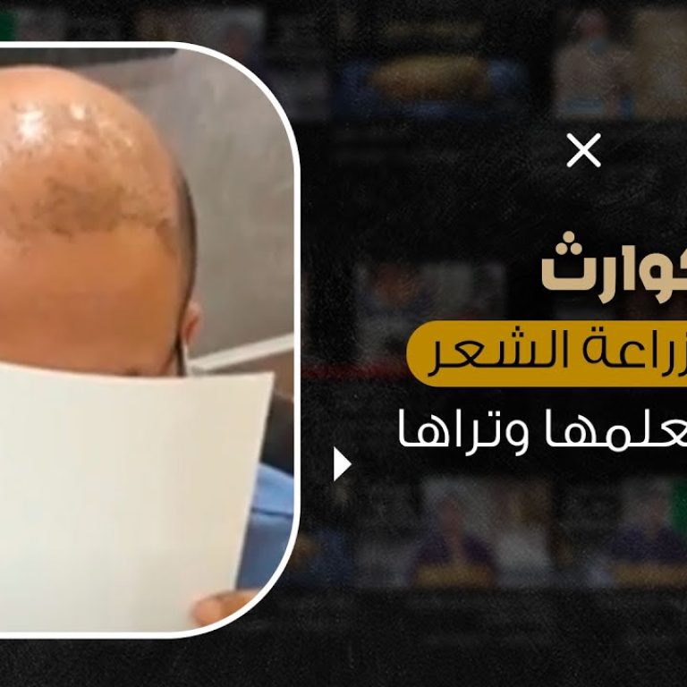 كوارث زراعة الشعر الطبيعي