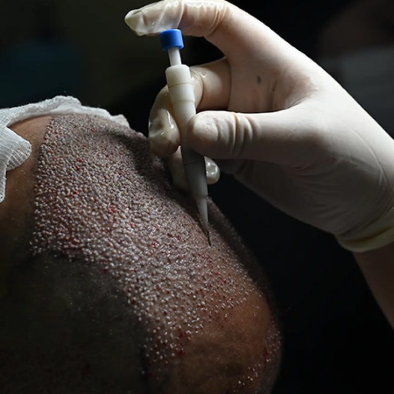 زراعة الشعر باقلام تشوي