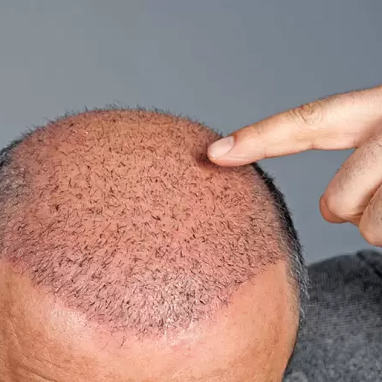 زراعة الشعر بالاستنساخ