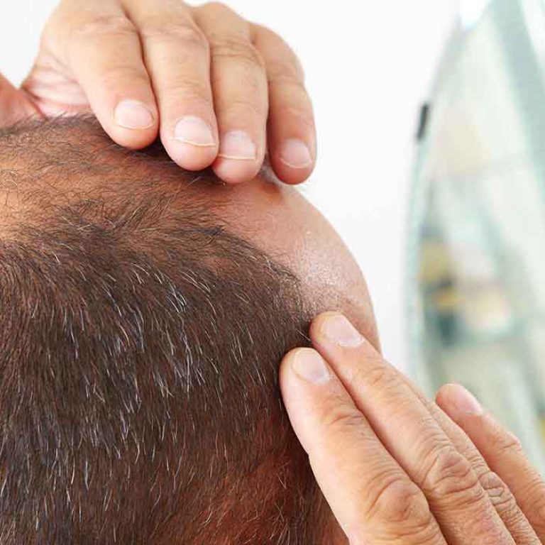 زراعة الشعر بالاقتطاف
