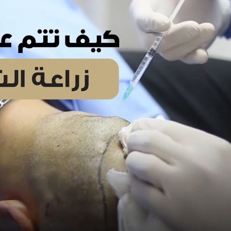 زراعة الشعر بالاقتطاف لصلع وراثي من درجه كبيرة