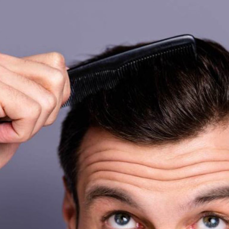 زراعة الشعر بالتقسيط