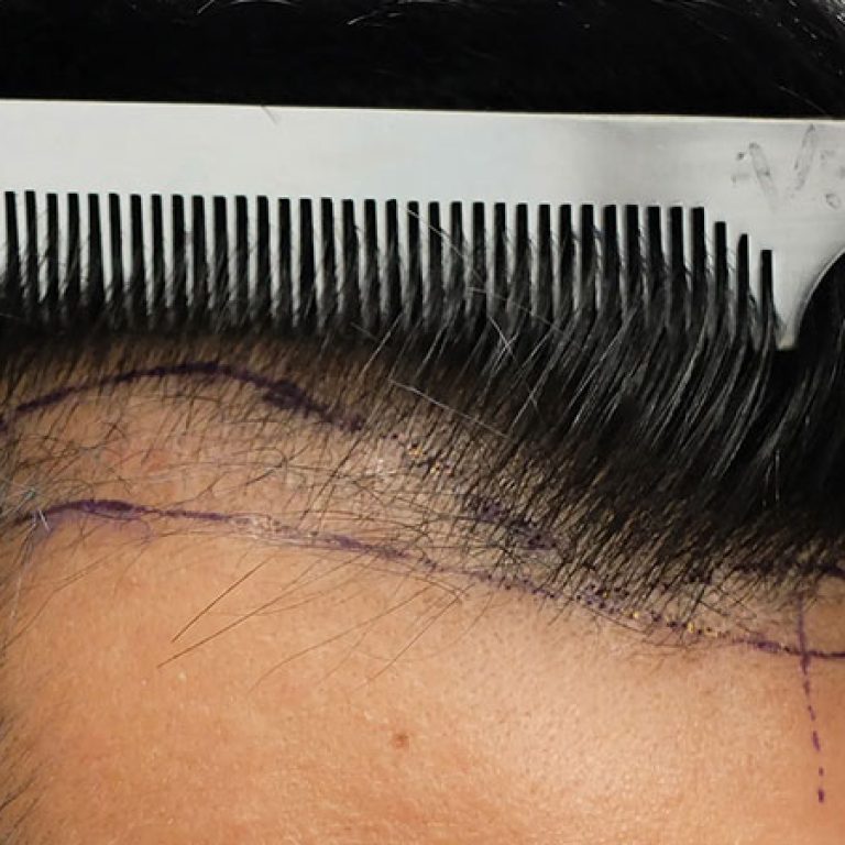زراعة الشعر بالتقسيط في مصر