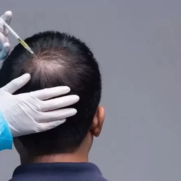 زراعة الشعر بالخلايا الجذعية