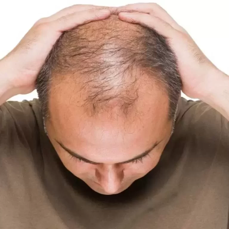 زراعة الشعر بالشريحة