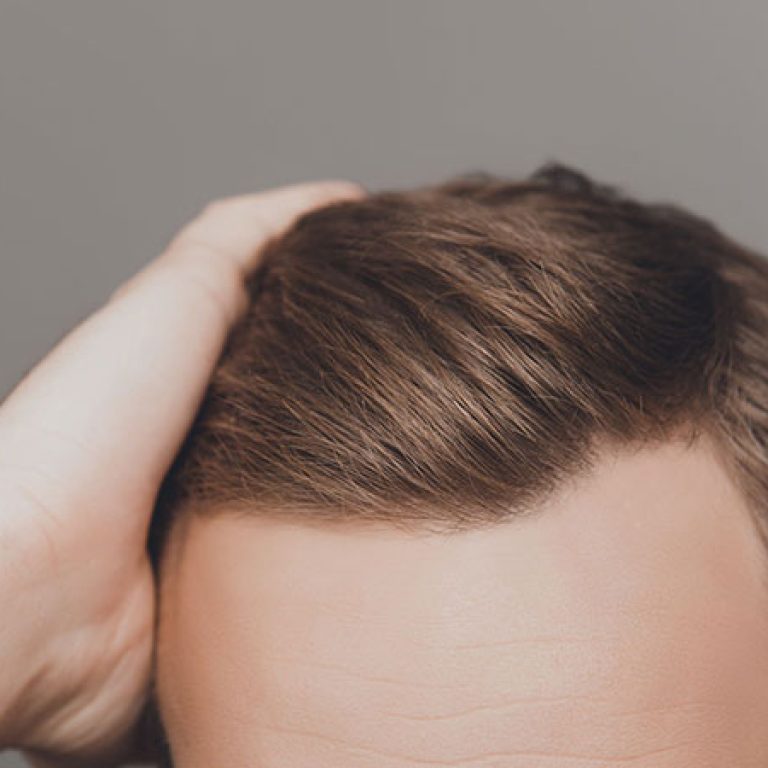 زراعة الشعر بالليزر