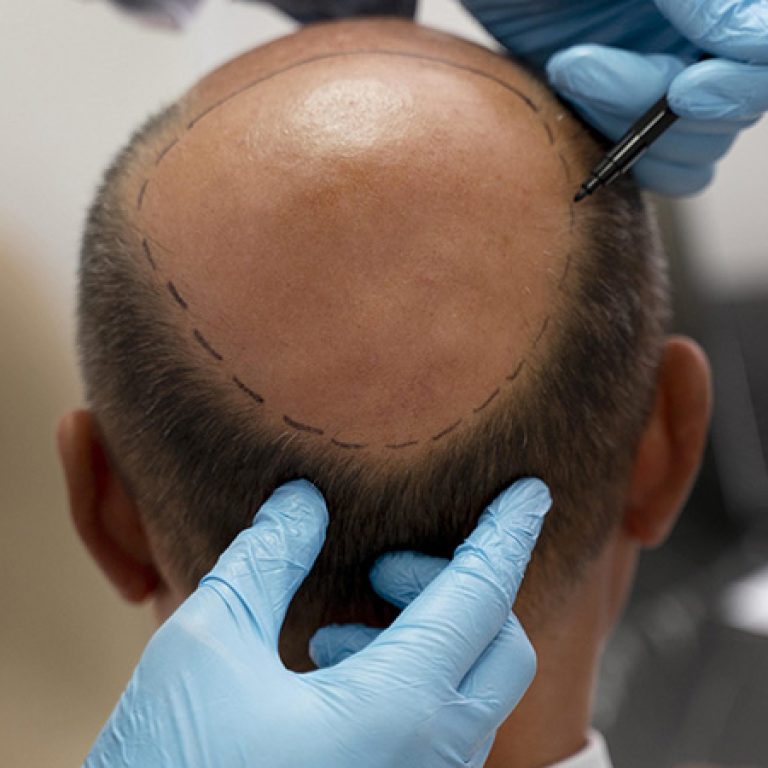زراعة الشعر بتقنية fue