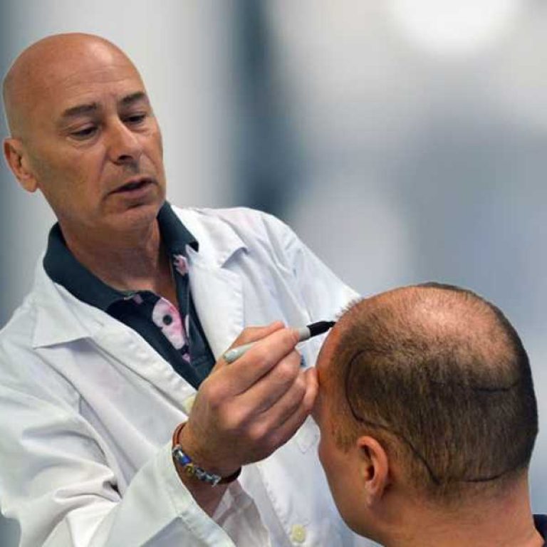 زراعة الشعر بتقنية الأقلام الذكية