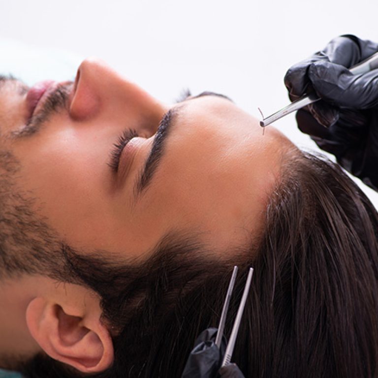 زراعة الشعر بتقنية الاقتطاف