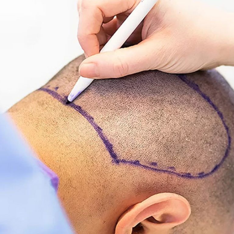 زراعة الشعر بتقنية البيركوتان