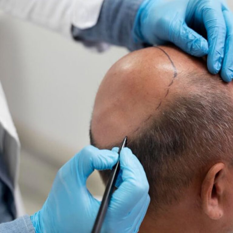 زراعة الشعر بتقنية السفير