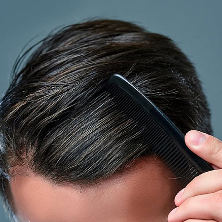 زراعة الشعر في الإمارات