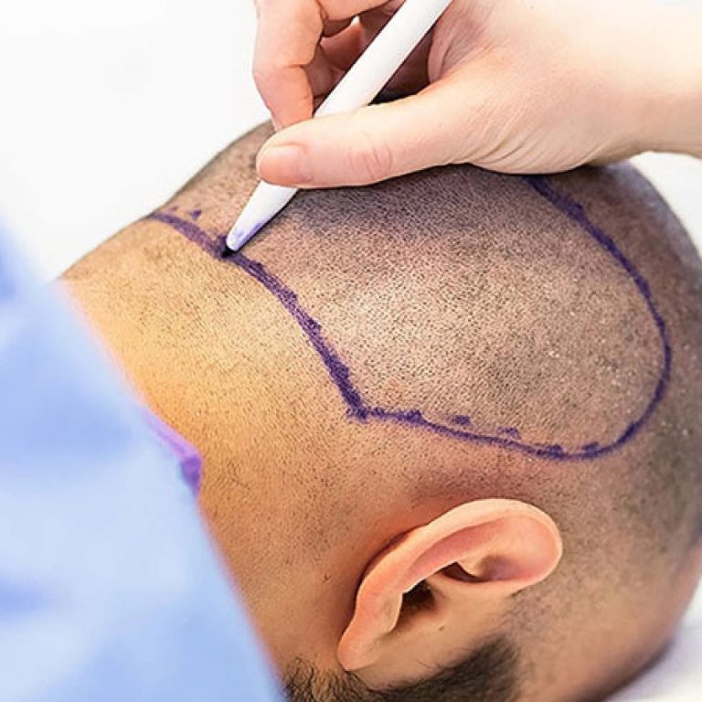زراعة الشعر في الدمام