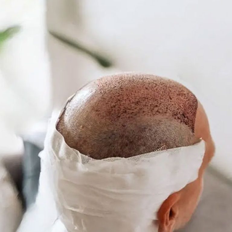 زراعة الشعر في الصيف