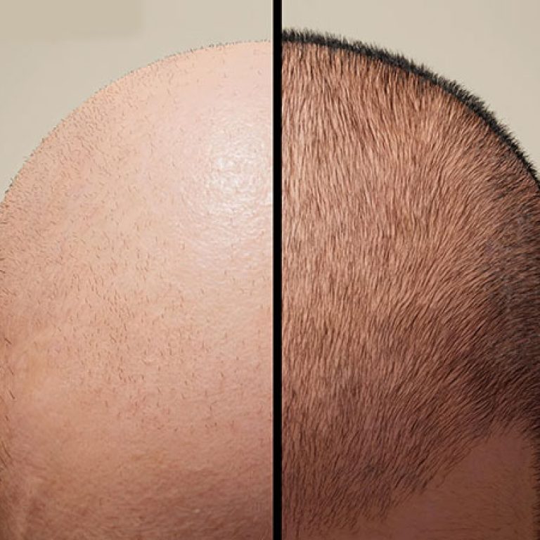 زراعة الشعر في الكويت