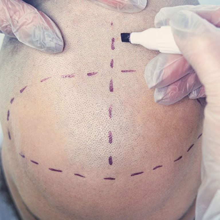 زراعة الشعر في قطر