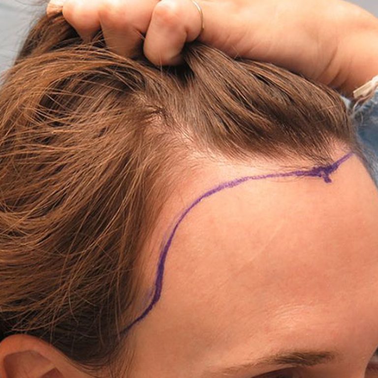 زراعة الشعر في مقدمة الرأس للنساء