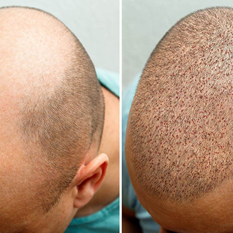 زراعة الشعر قبل وبعد