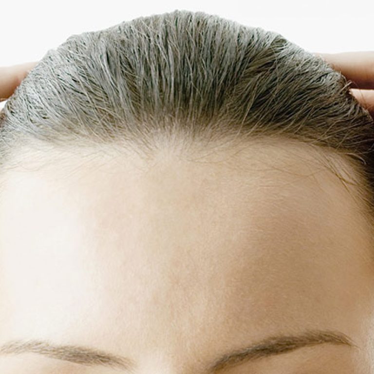زراعة الشعر لتصغير الجبهة