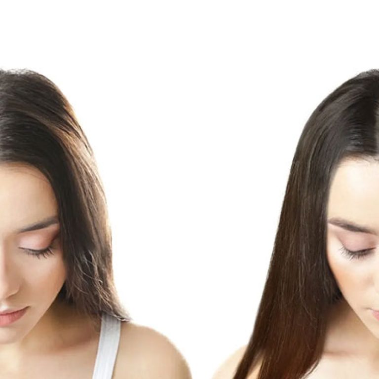زراعة الشعر للبنات