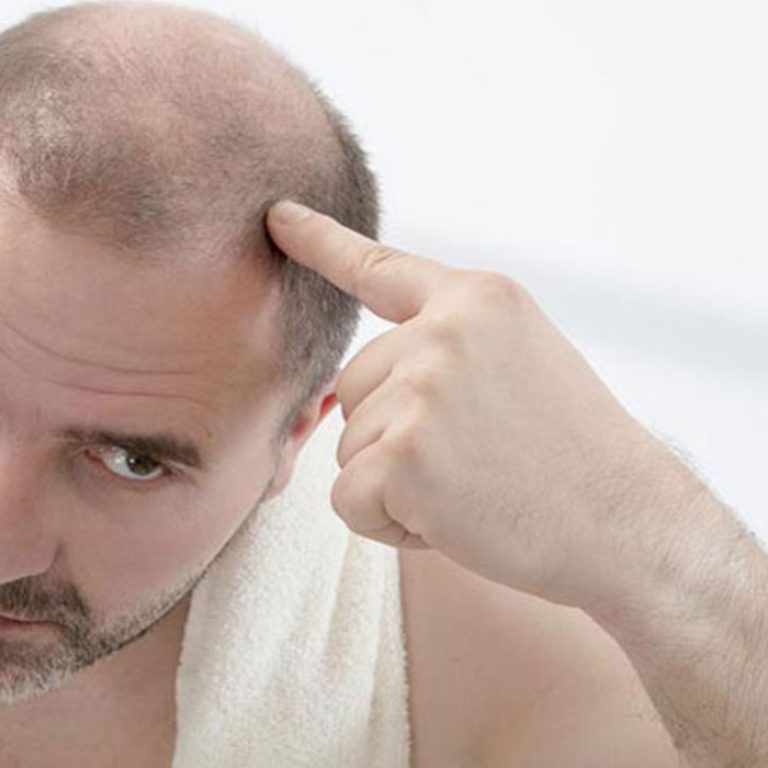 زراعة الشعر للرجال