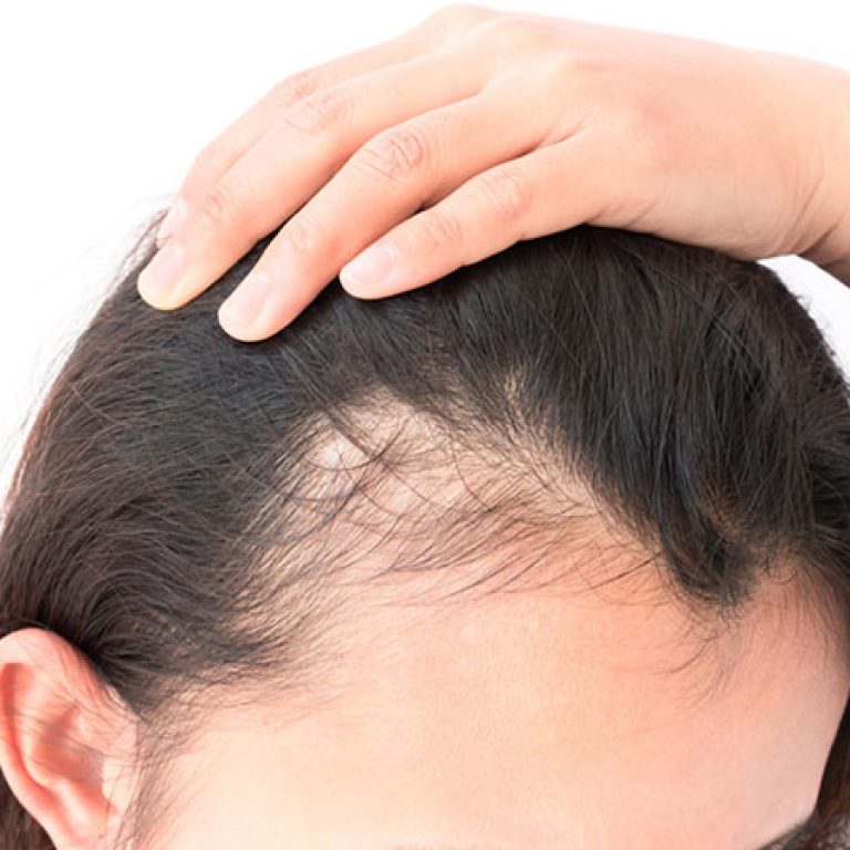 زراعة الشعر للنساء