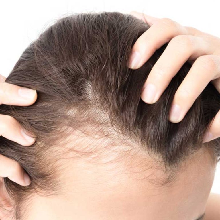 زراعة الشعر للنساء