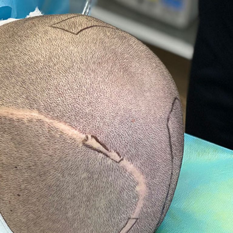 زراعة الشعر مكان الجروح