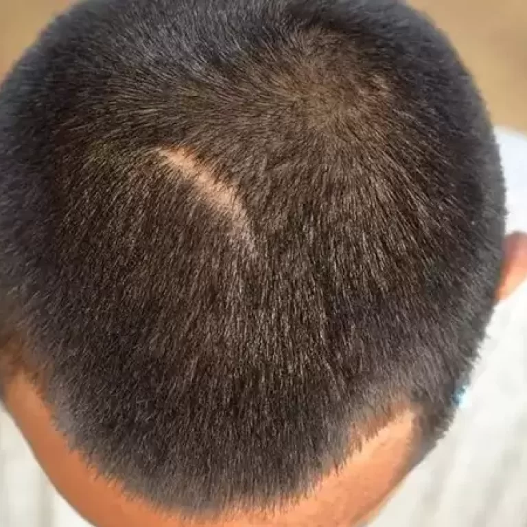 زراعة الشعر مكان الخياطة