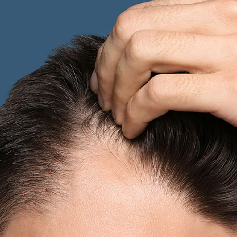 زراعة الشعر من الجسم