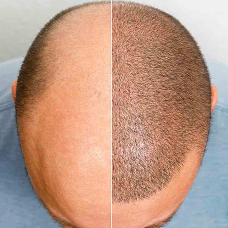 زراعة الشعر من متبرع