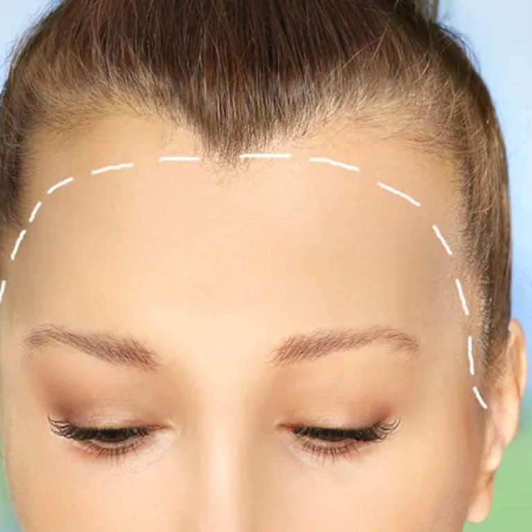 زراعة شعر الجبهة للنساء