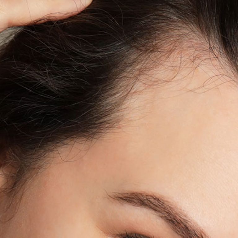 زراعة شعر الجبهة للنساء في مصر