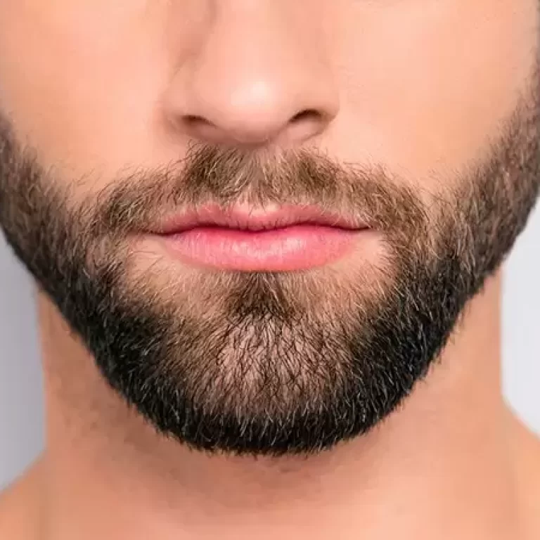 زراعة شعر الذقن