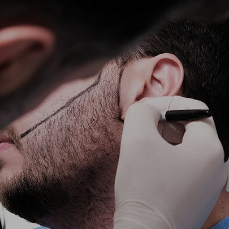 زراعة-شعر-الذقن