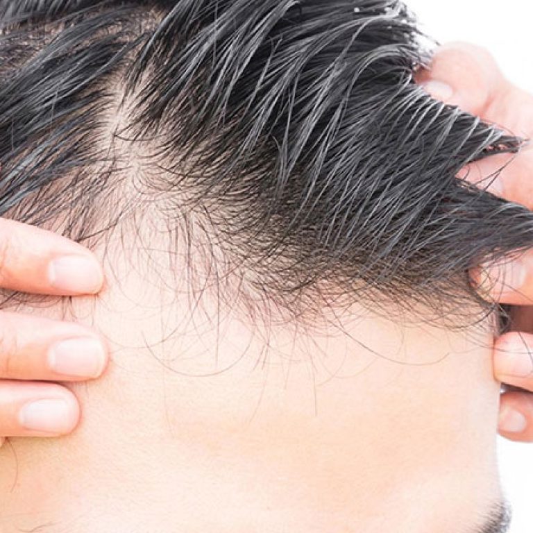 زراعة شعر صناعي