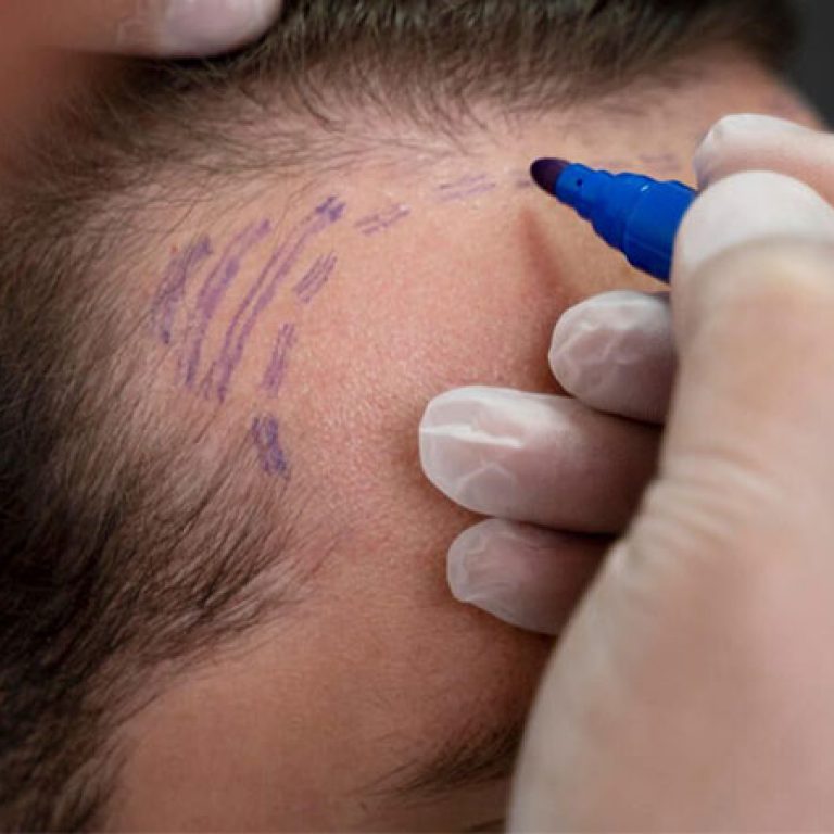 زراعة شعر في الرياض